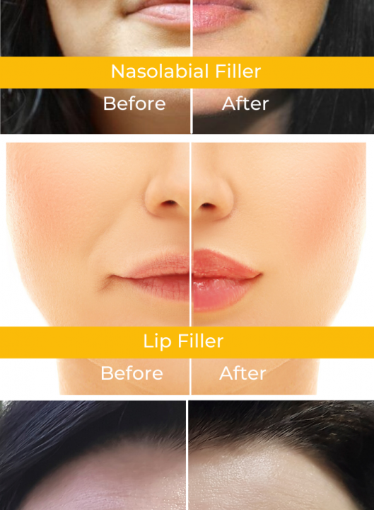 Botox fillers before after digital