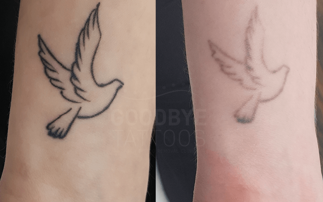 Tattoo removal digital photo
