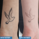 Tattoo removal digital photo