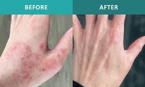 eczema digital