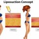 liposuction digital