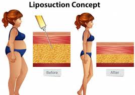 liposuction digital