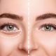 under eye fillers