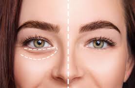 under eye fillers