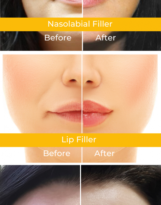 Botox fillers before after digital