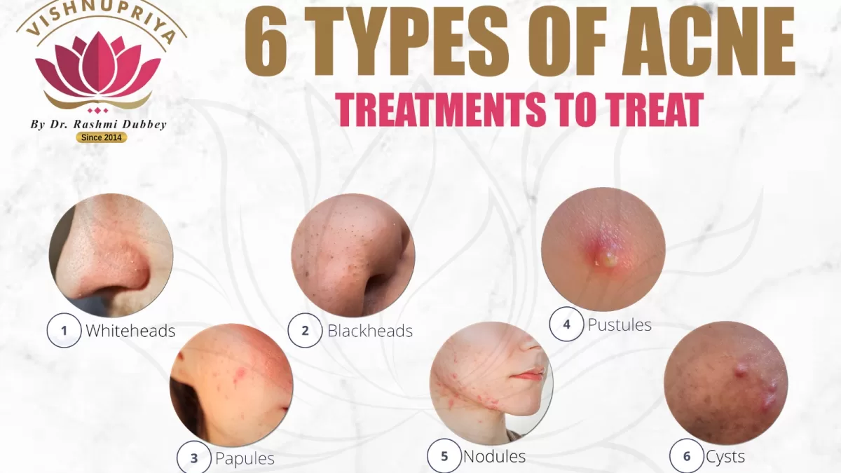 6-type-acne-treatement