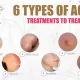 6-type-acne-treatement