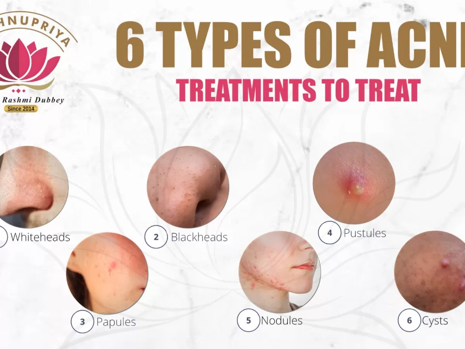 6-type-acne-treatement