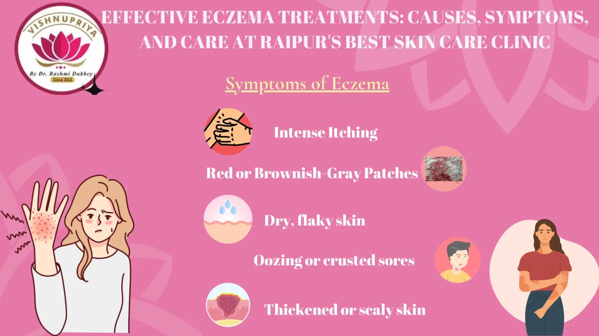 Eczema Treatments