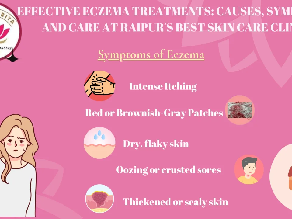 Eczema Treatments