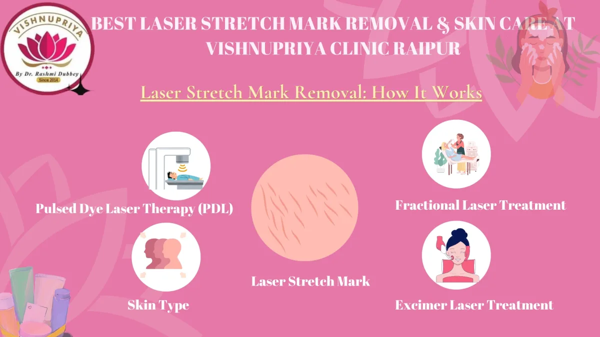 laser stretch mark removal